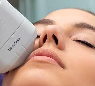 HIFU y Radiofrecuencia