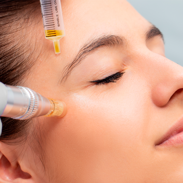 Mesoterapia Fraccionada